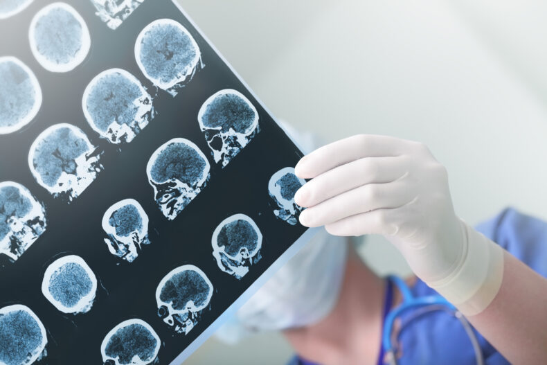 Doctor examining brain scan x-ray