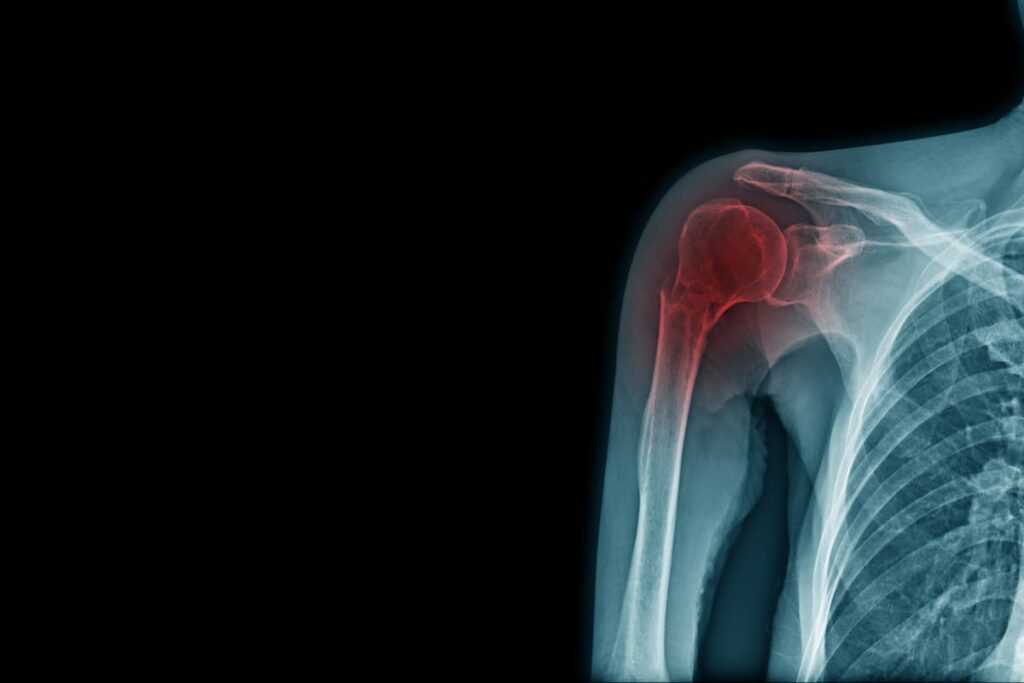 x-ray fracture of acromion process and neck of humerus bone