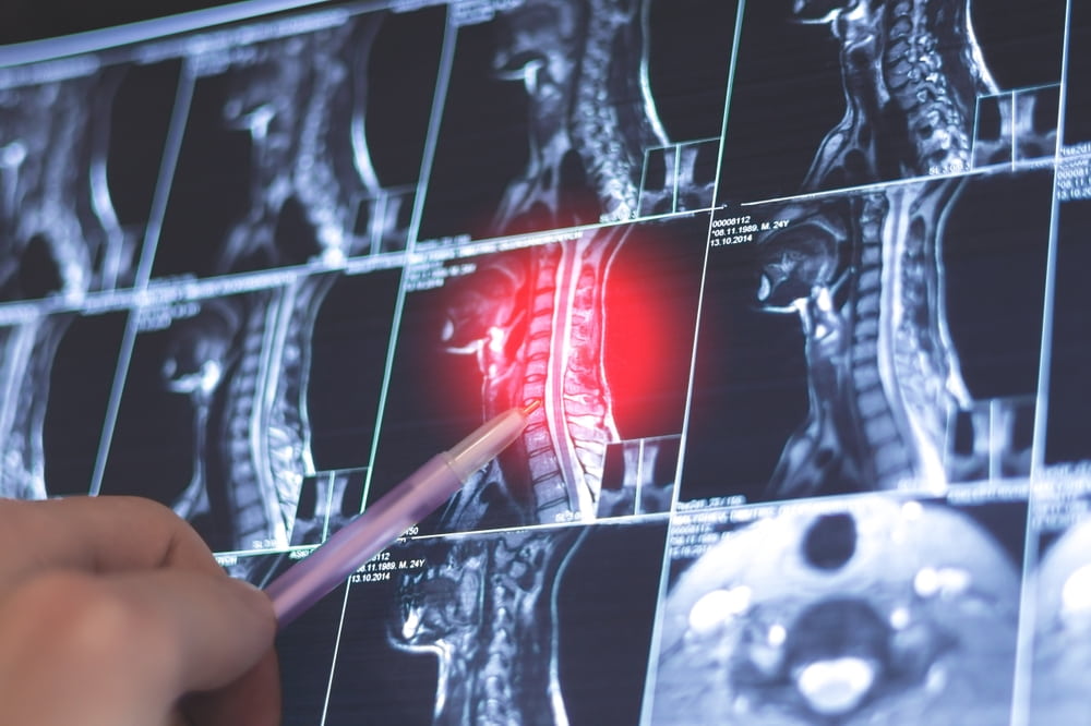 Doctor pointing at highlighted neck injury on MRI scan images
